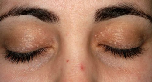 riesgos de los tatuajes oculares que debes conocer 3