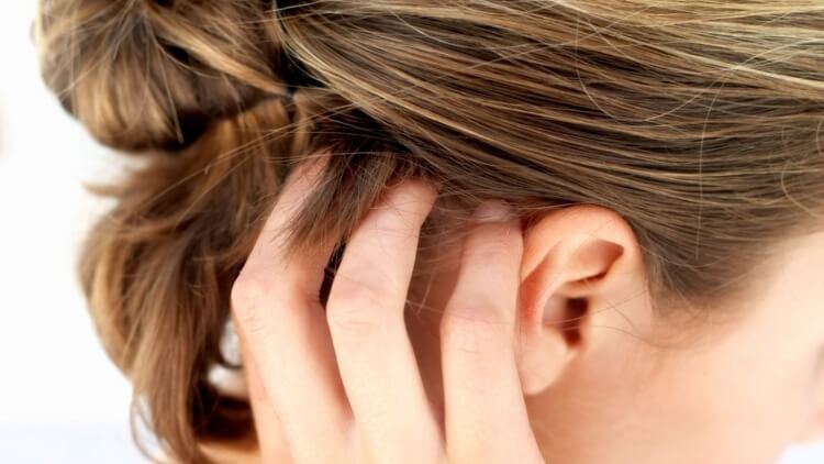 Caspa interminable ¿Cómo resolver los inconvenientes? 7 - 【MioEstilo】 tratamiento para la psoriasis en el cuero cabelludo